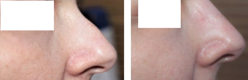 Γλυπτική μύτης πριν και μετά