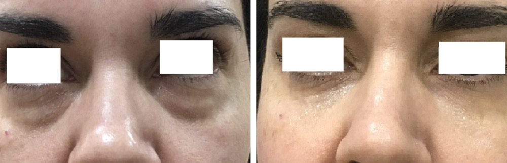 Πριν και μετά τη θεραπεία στη περιοχή των ματιών